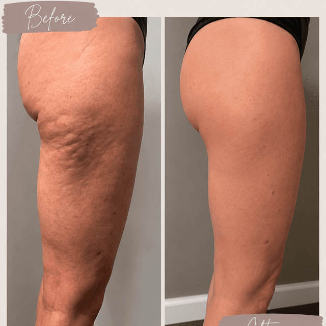 Sculpted Legs Reset at Organic Love Wellness in La Jolla, CA